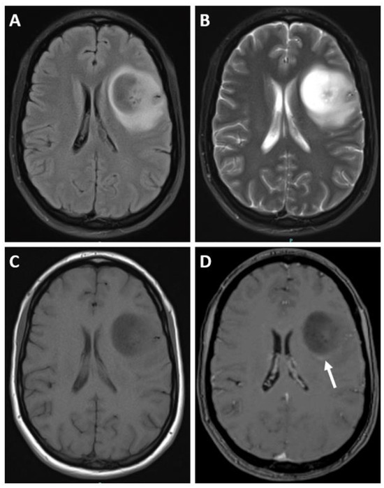 Central Nervous System Tumors 裁断済み Molecular neuropathology: an essential and evolving toolbox