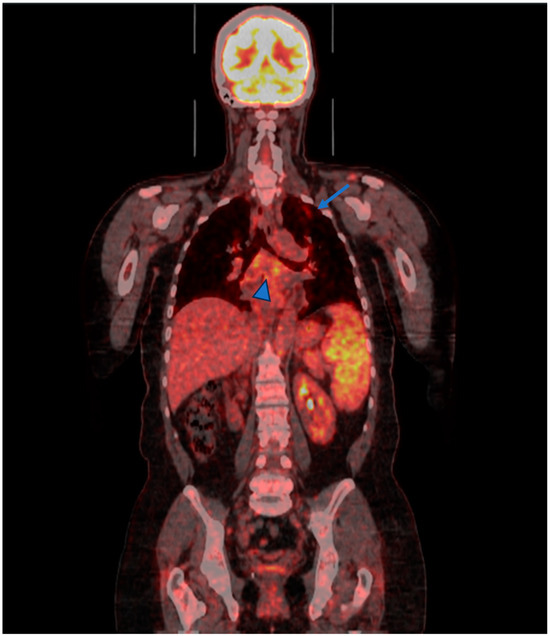 Sarcoidosis versus Granulomatous and Lymphocytic