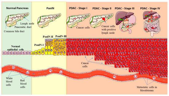 Using microRNAs Networks to Understand Pancreatic Cancer—A