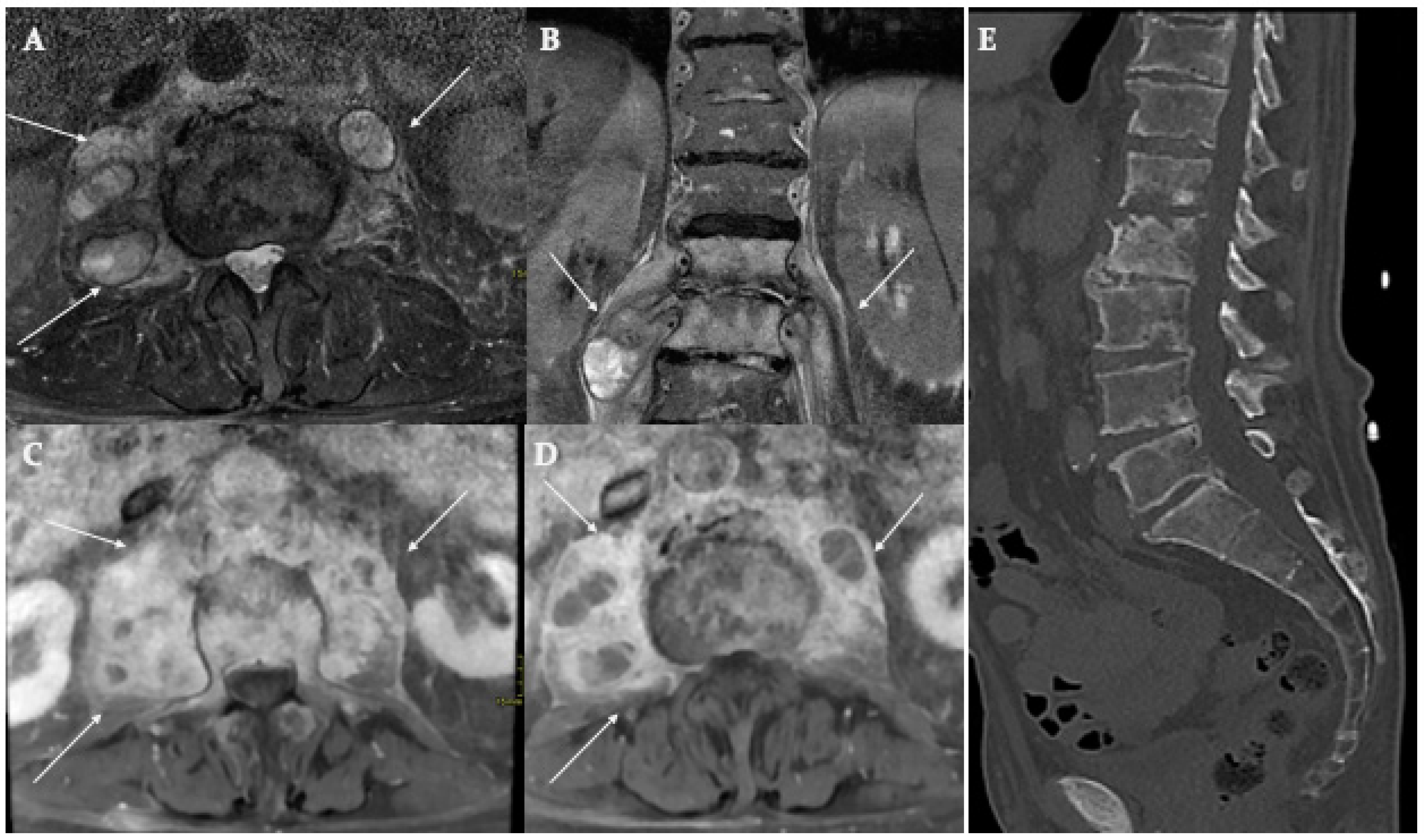 Spondylodiscitis and Its Mimickers: A Pictorial Review