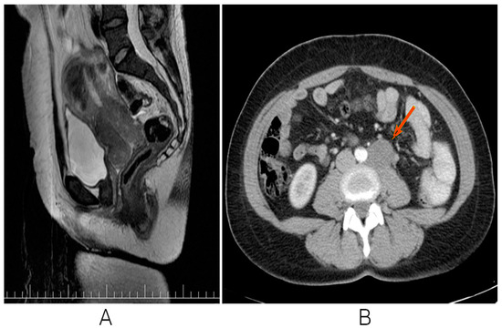 PET CT Imaging with FDG in the Therapeutical Management of