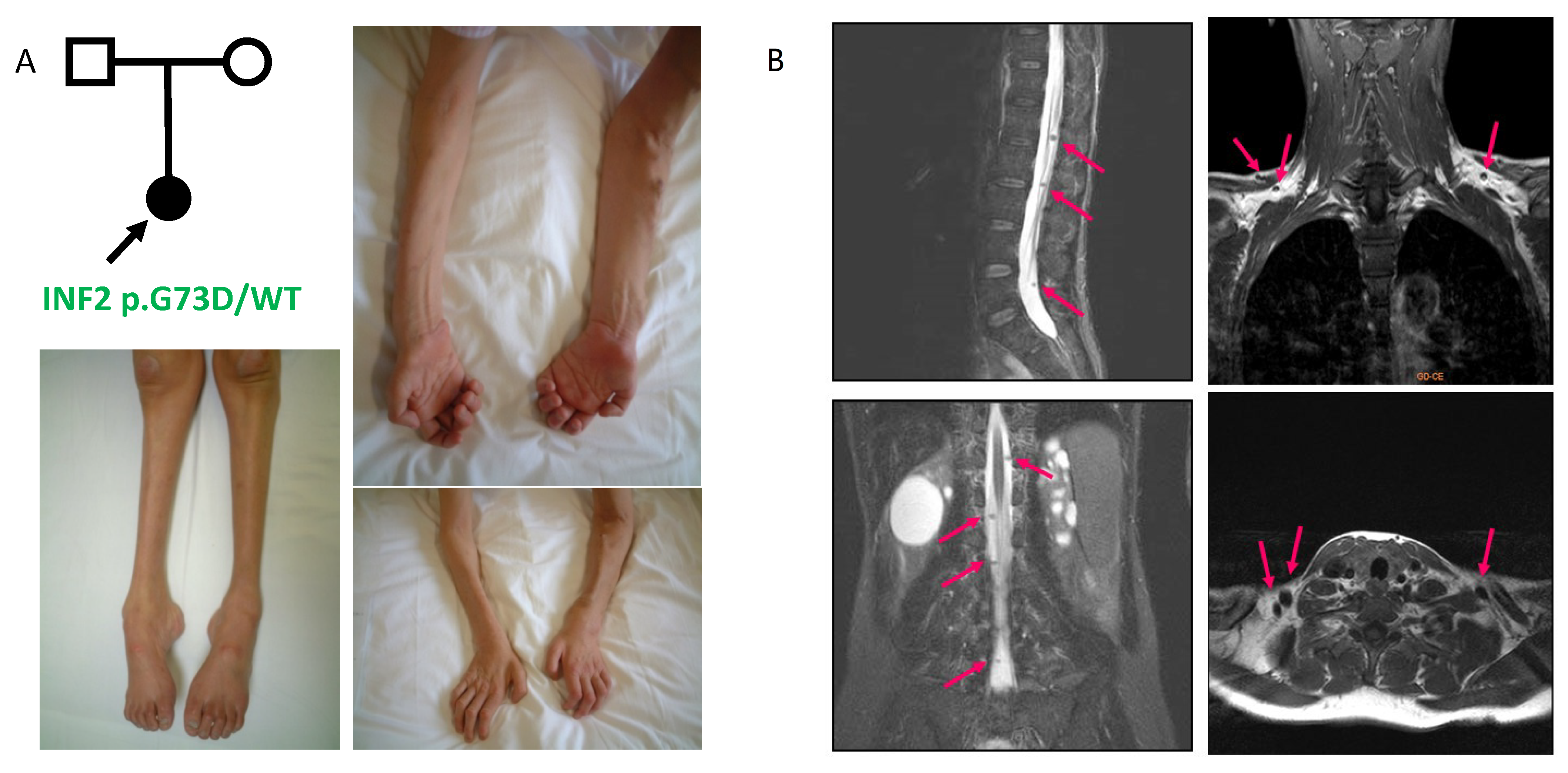 Nerve Enlargement in Patients with INF2 Variants Causing 