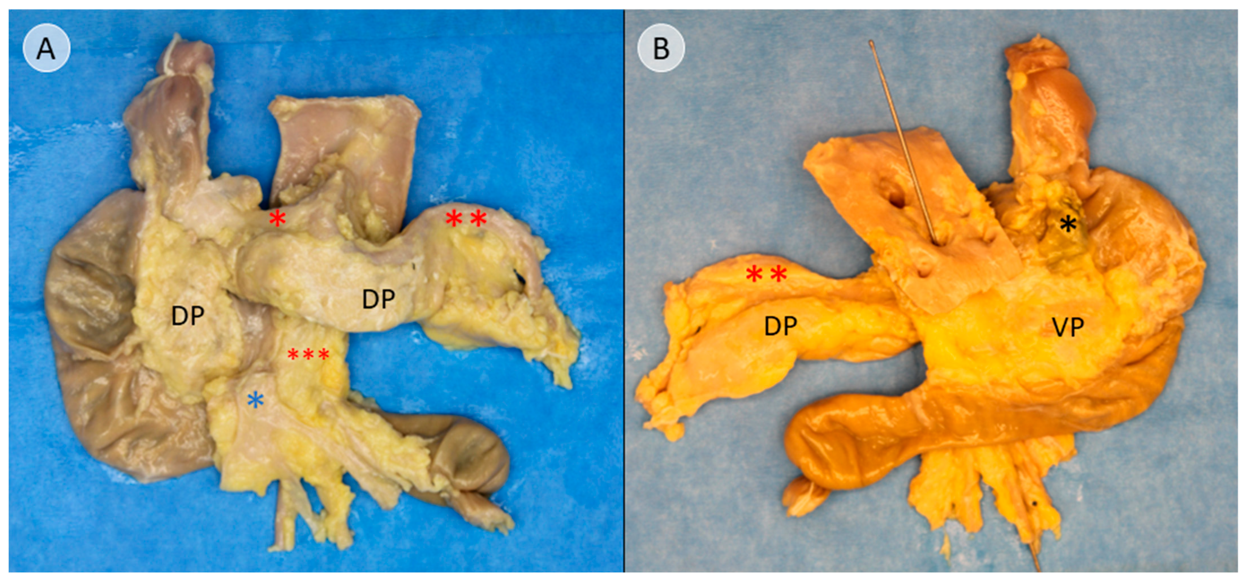 ⚠裁断済み　乳頭再建 = Papilla reconstruction Entire Papilla Preservation Technique with Enamel Matrix