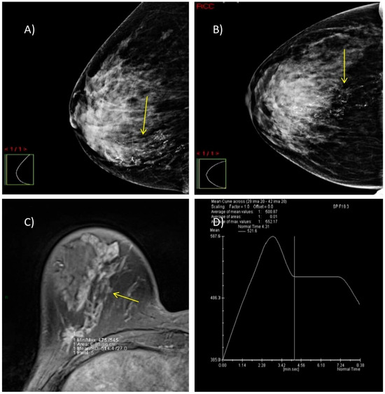 Diagnostic Breast Imaging 第2版 Diagnostic Imaging: Breast: 9780323548120: Medicine & Health