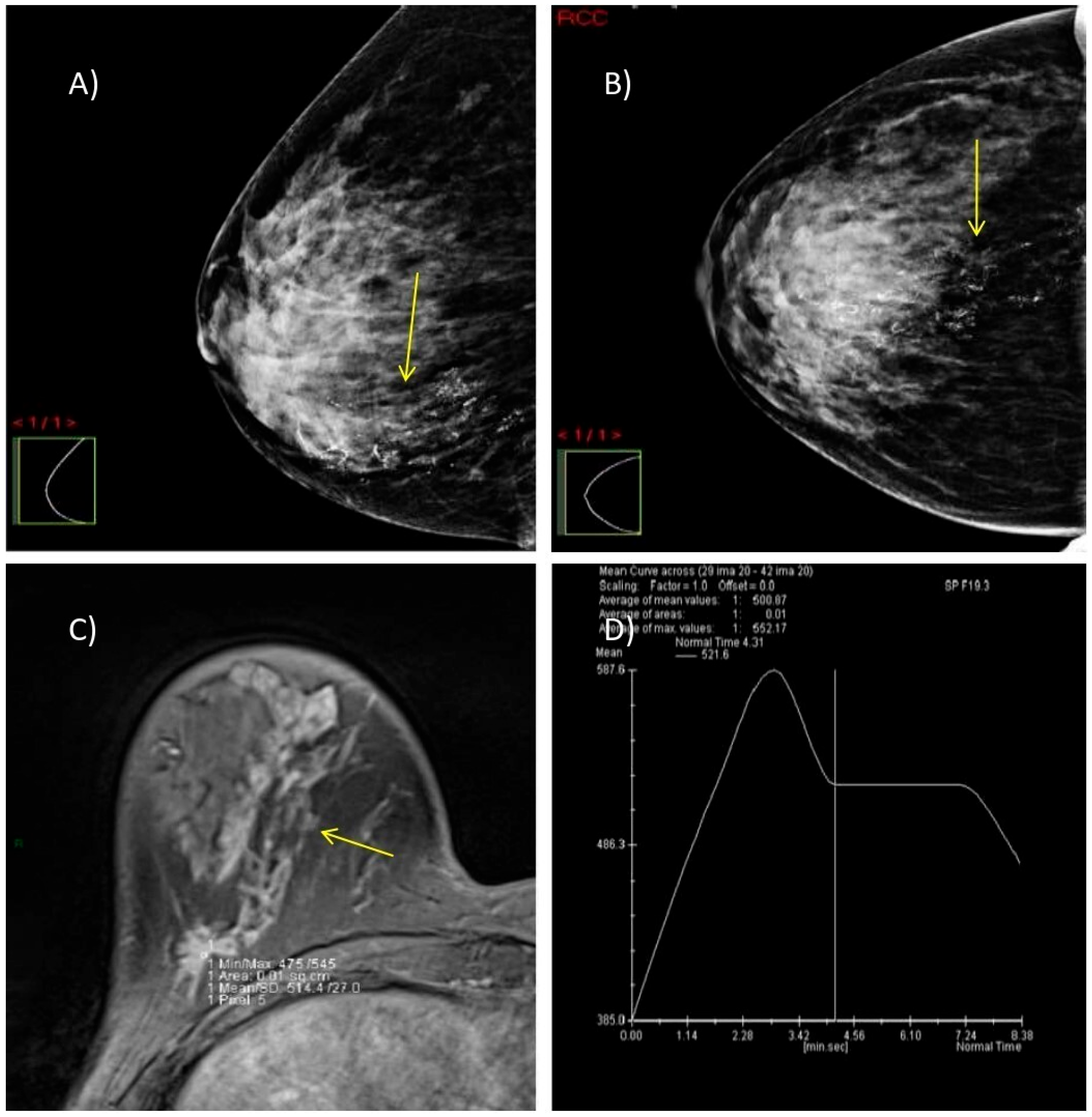Comparative Diagnostic Efficacy of Four Breast Imaging
