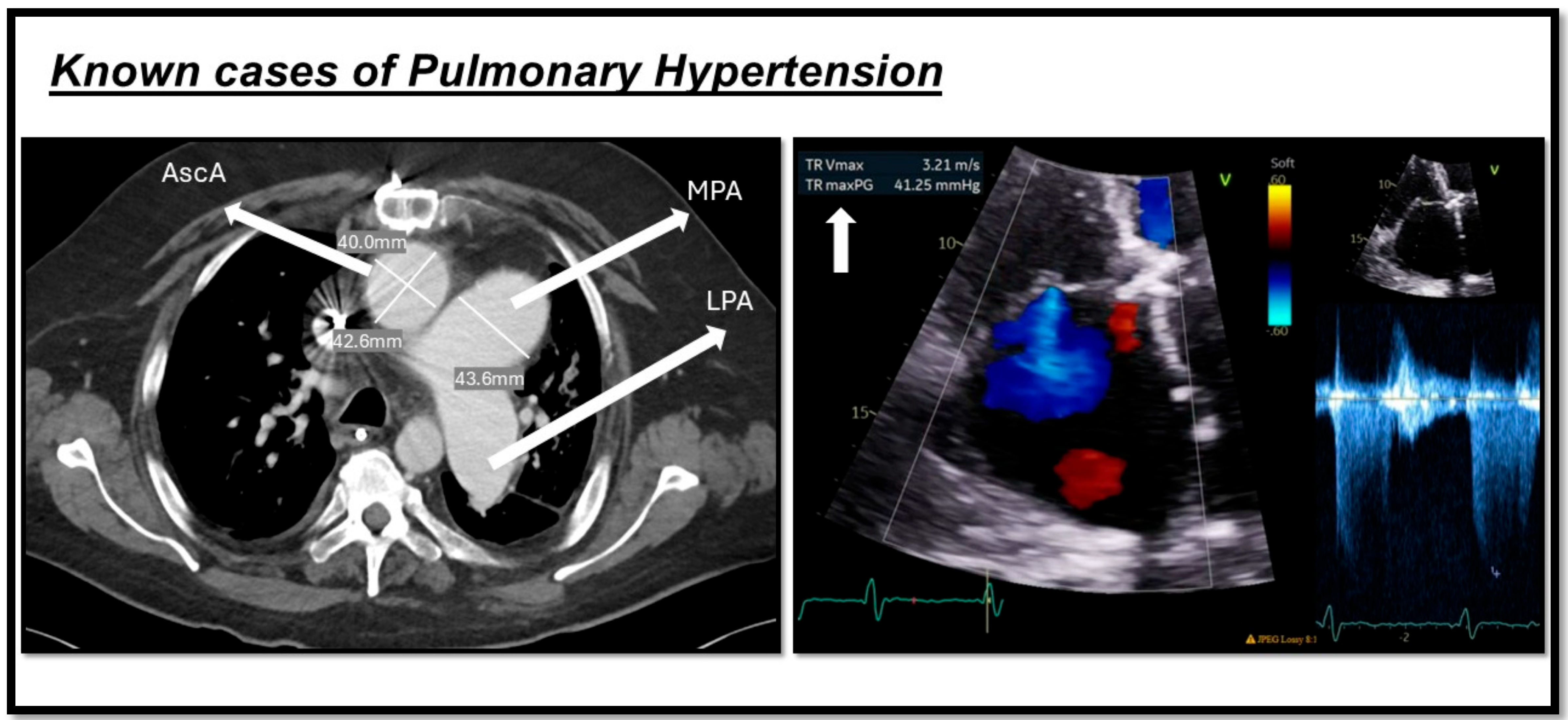 State of the Art in Pulmonary Arterial Hypertension