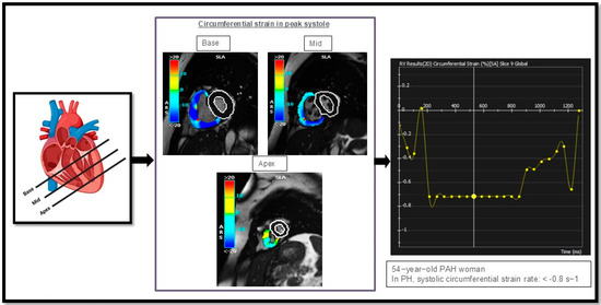 pH  State of the Art in Pulmonary Arterial Hypertension