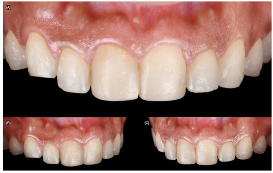 Bonding Protocols for Lithium Disilicate Veneers: A Narrative Review ...
