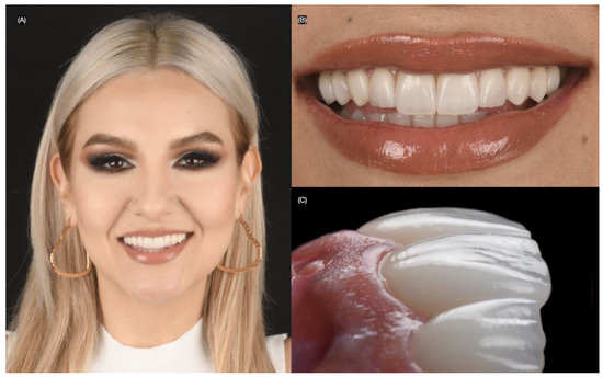 Bonding Protocols for Lithium Disilicate Veneers: A Narrative Review ...