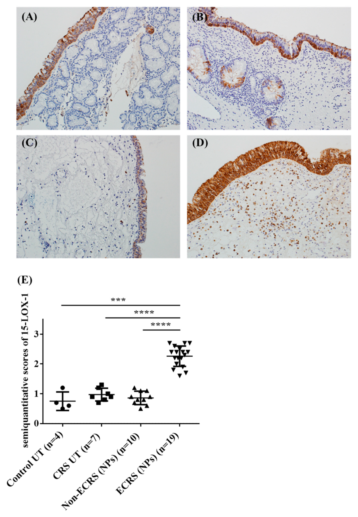 sinus papilloma b3