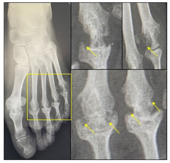 Rheumatoid Arthritis in the View of Osteoimmunology