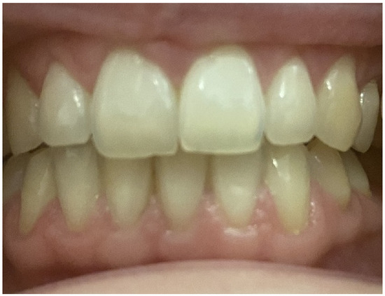 Biomolecules Free Full Text Prepubertal Periodontitis In A Patient With Combined Classical And Periodontal Ehlers Danlos Syndrome