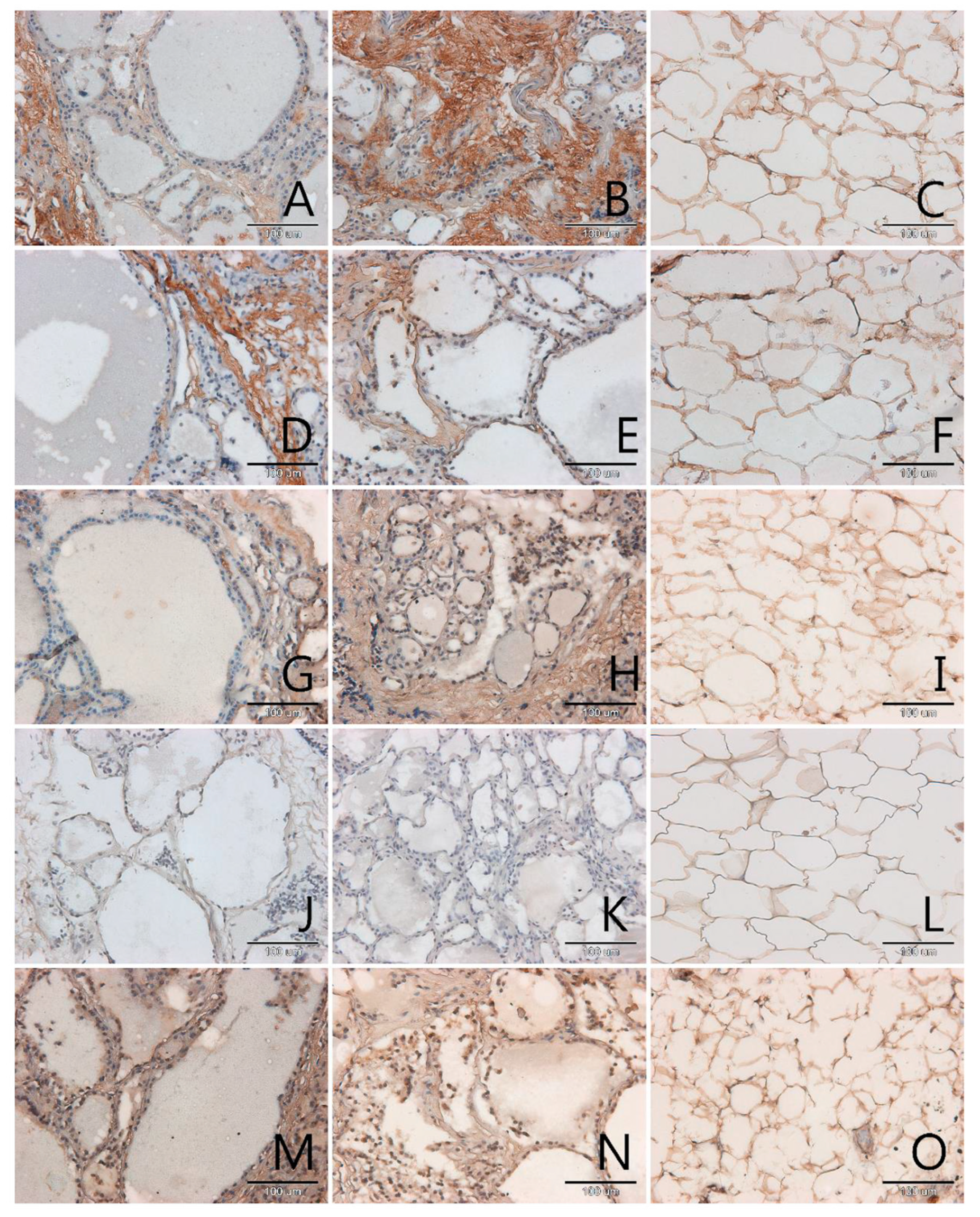 Biomolecules Free Full Text Contribution Of Glycation And Oxidative Stress To Thyroid Gland Pathology A Pilot Study Html