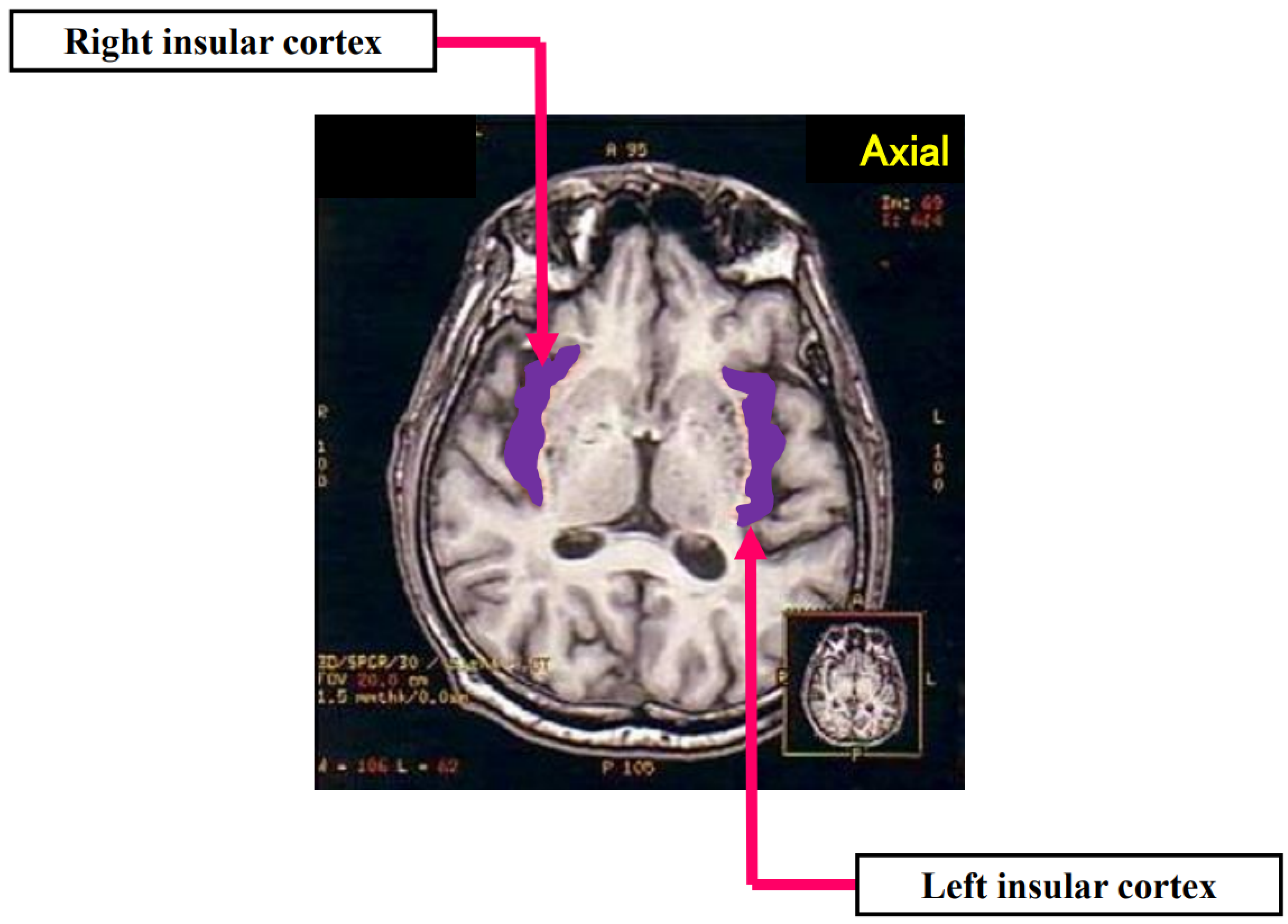 napadow et al. human brain mapping 2007 napadow et al. human brain mapping 2007