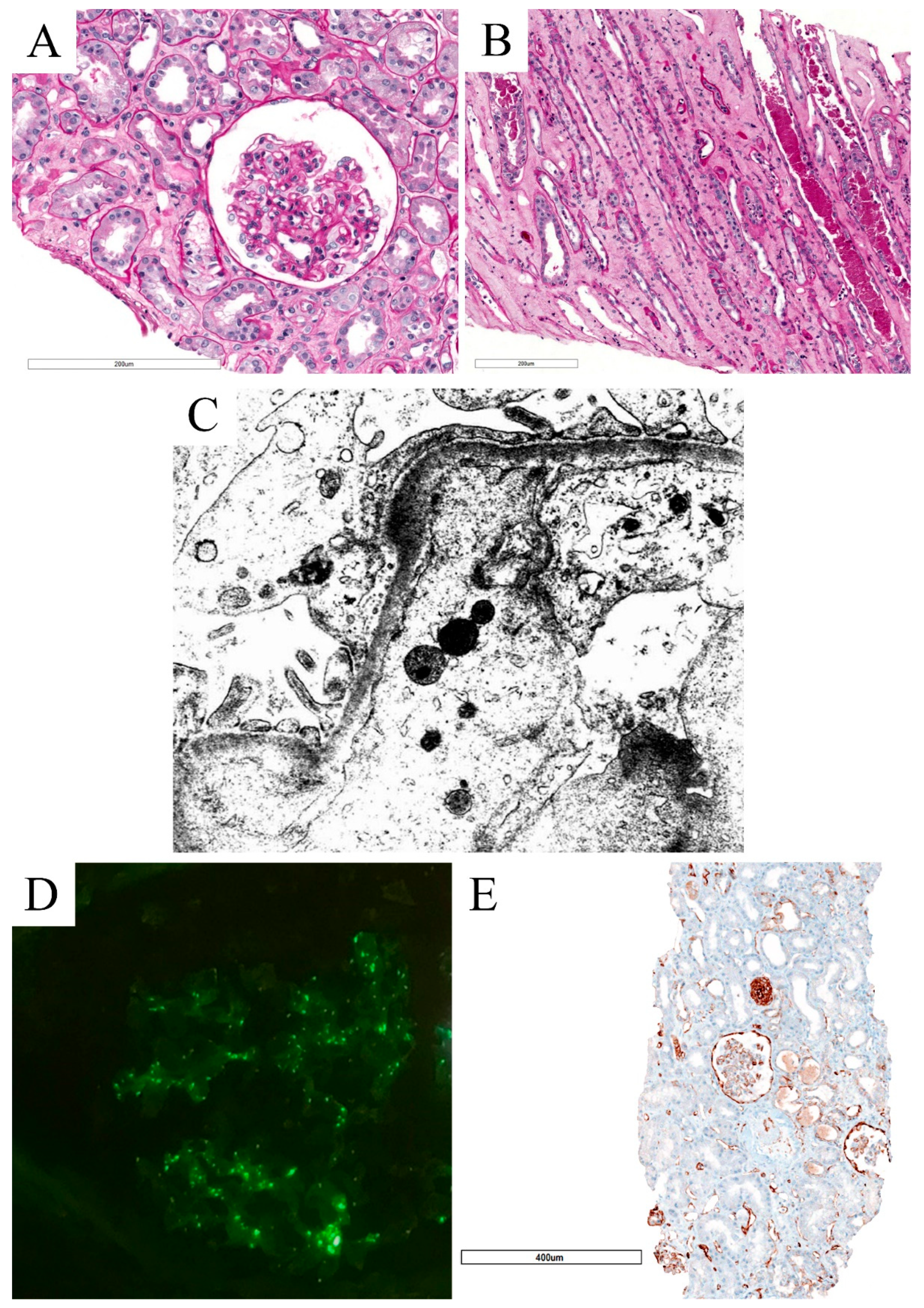 Biomolecules Free Full-Text Spectrum of Kidney Injury Following COVID-19 Disease Renal Biopsy Findings in a Single Italian Pathology Service pic image
