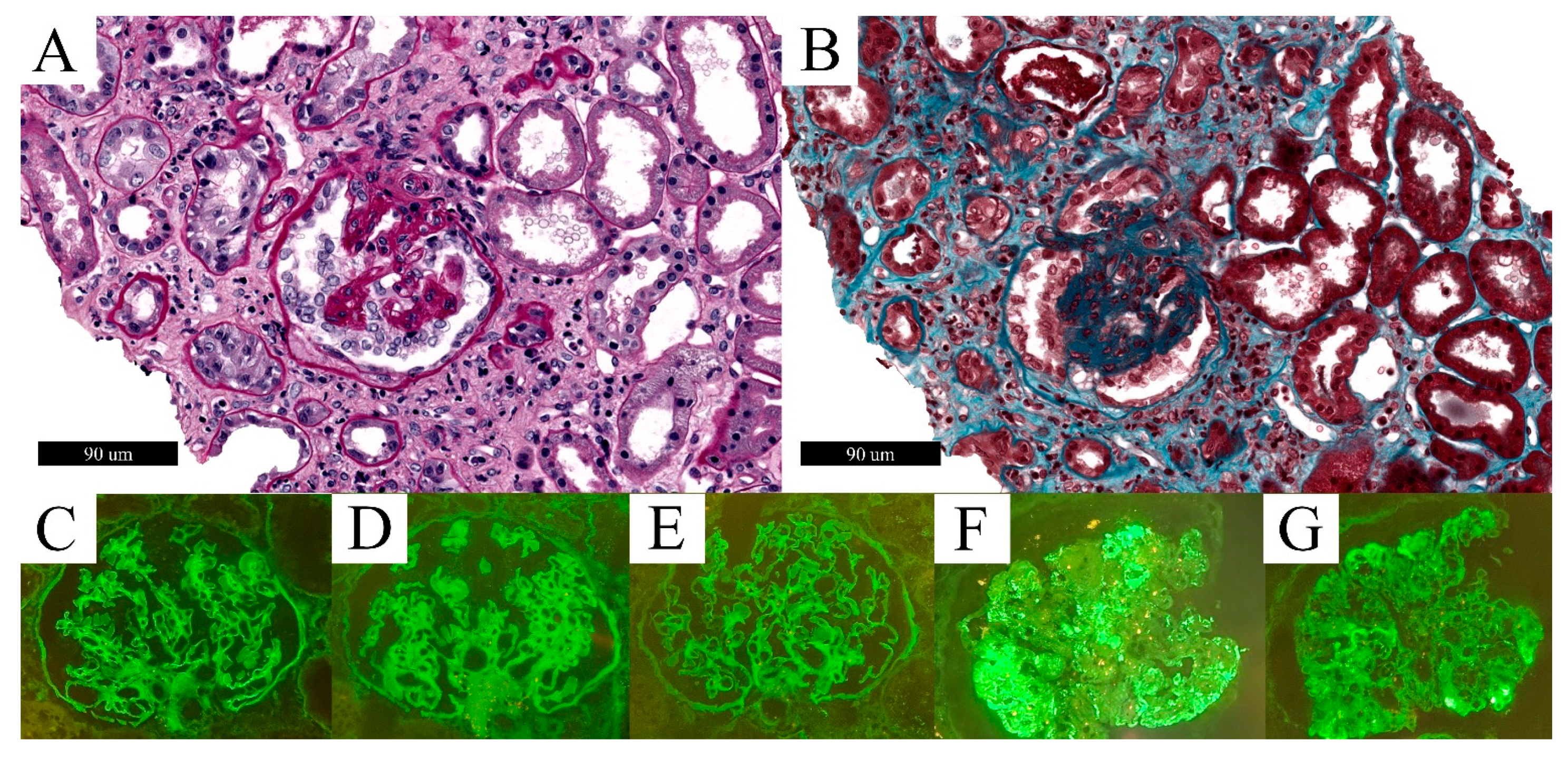 Biomolecules Free Full-Text Spectrum of Kidney Injury Following COVID-19 Disease Renal Biopsy Findings in a Single Italian Pathology Service image