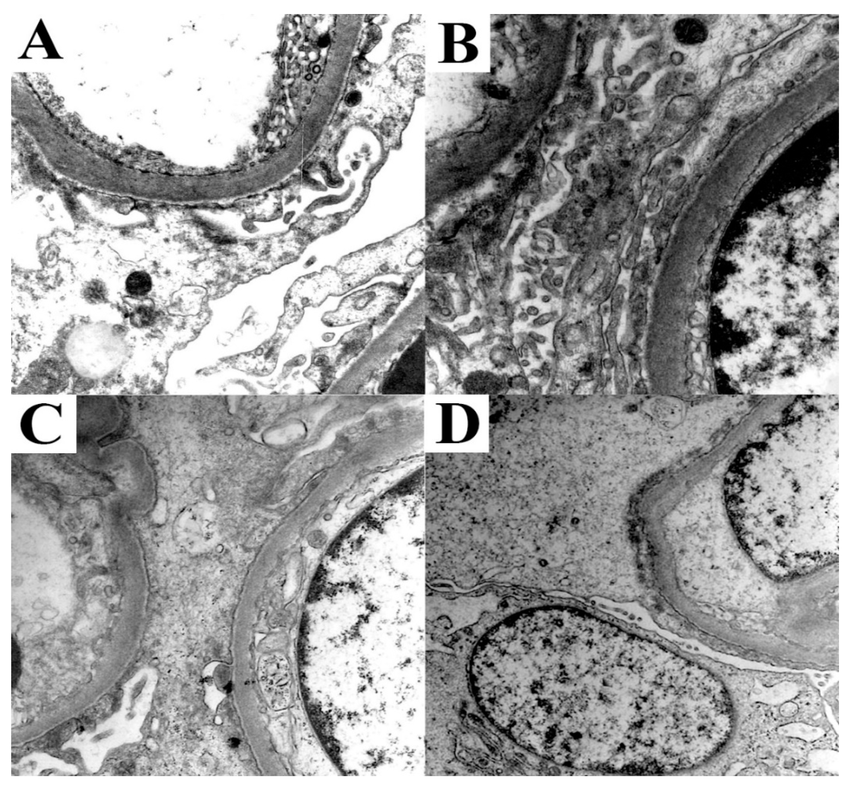 Biomolecules Free Full-Text Spectrum of Kidney Injury Following COVID-19 Disease Renal Biopsy Findings in a Single Italian Pathology Service