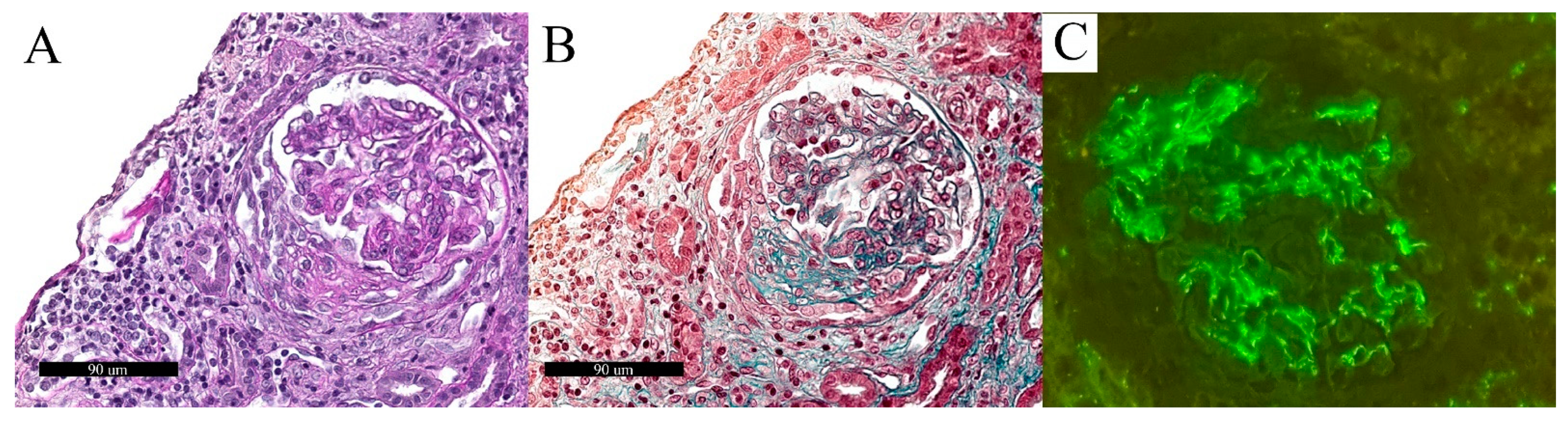 Biomolecules Free Full-Text Spectrum of Kidney Injury Following COVID-19 Disease Renal Biopsy Findings in a Single Italian Pathology Service