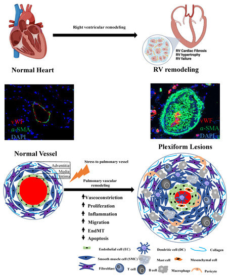Biomolecules | Free Full-Text | The Landscape of Noncoding RNA in Pulmonary Hypertension Biomolecules | Free Full-Text | The Landscape of Noncoding RNA in Pulmonary Hypertension