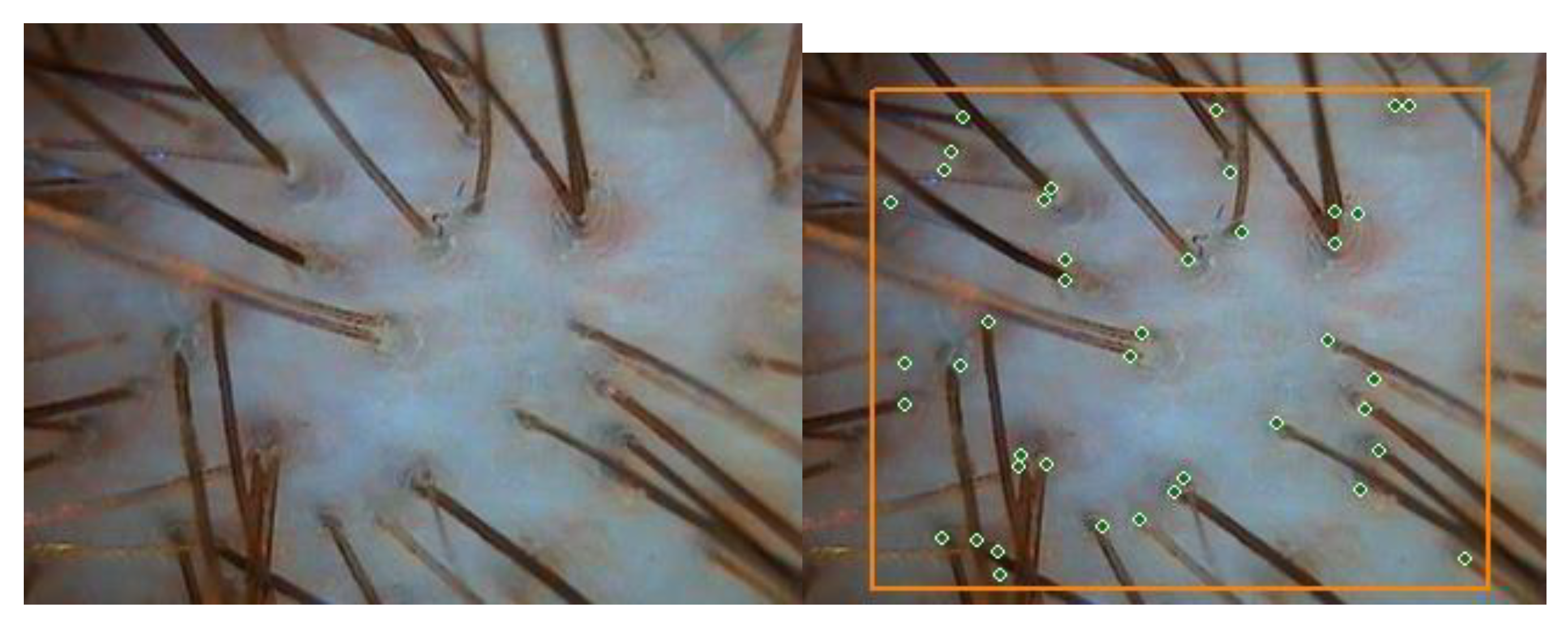 Congenital Hair Follicle Deficiency (Hypotrichosis) | GL Perrault MD | Hair  Loss and Hair Restoration