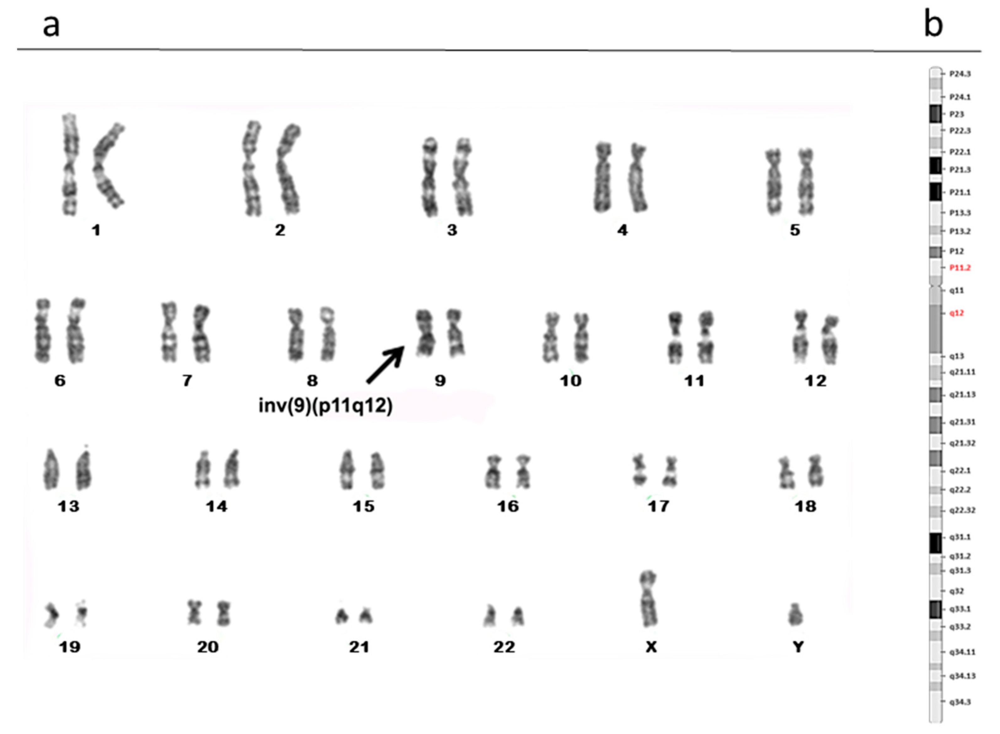 Biomolecules Free FullText Polymorphic Rearrangements of Human