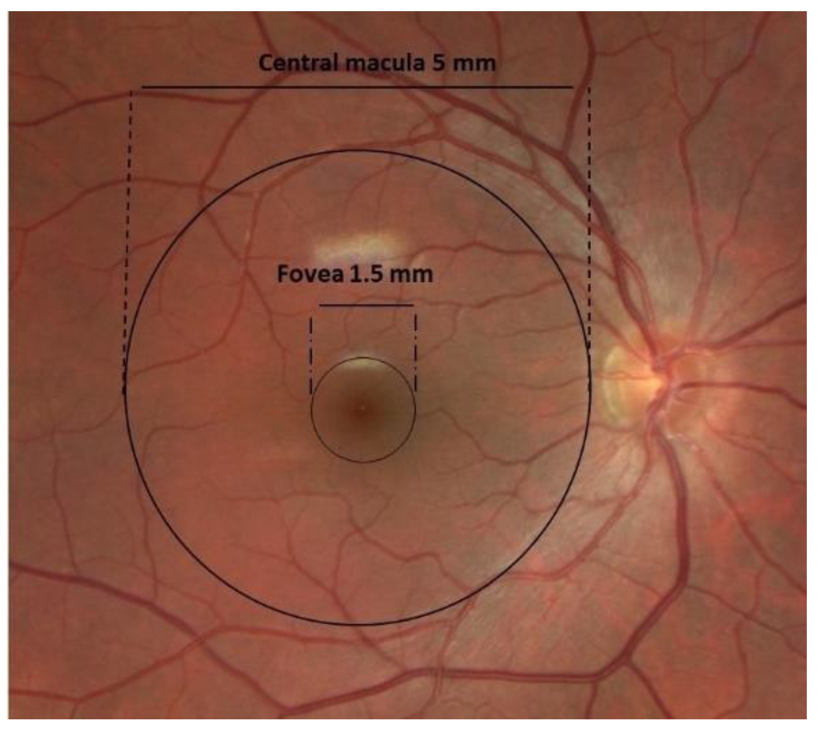 Macular degeneration