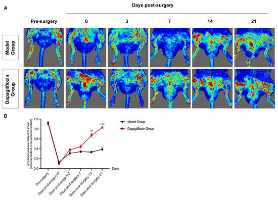 Dapagliflozin Improves Angiogenesis after Hindlimb Ischemia
