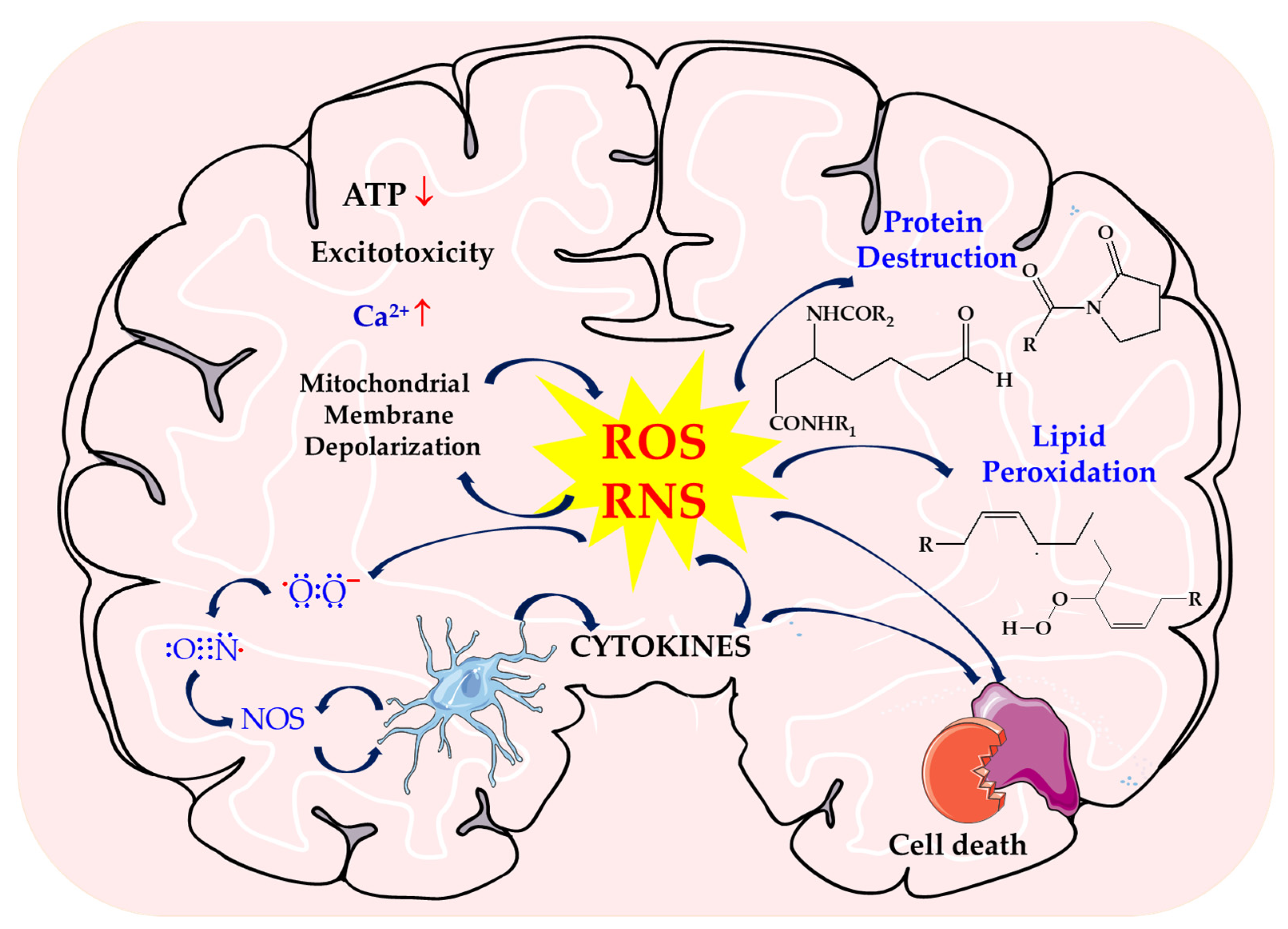 The Influence of Oxidative Stress Markers in Patients with Ischemic Stroke