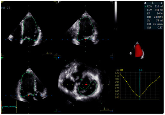 The Functional and Imaging Implications of Left Bundle