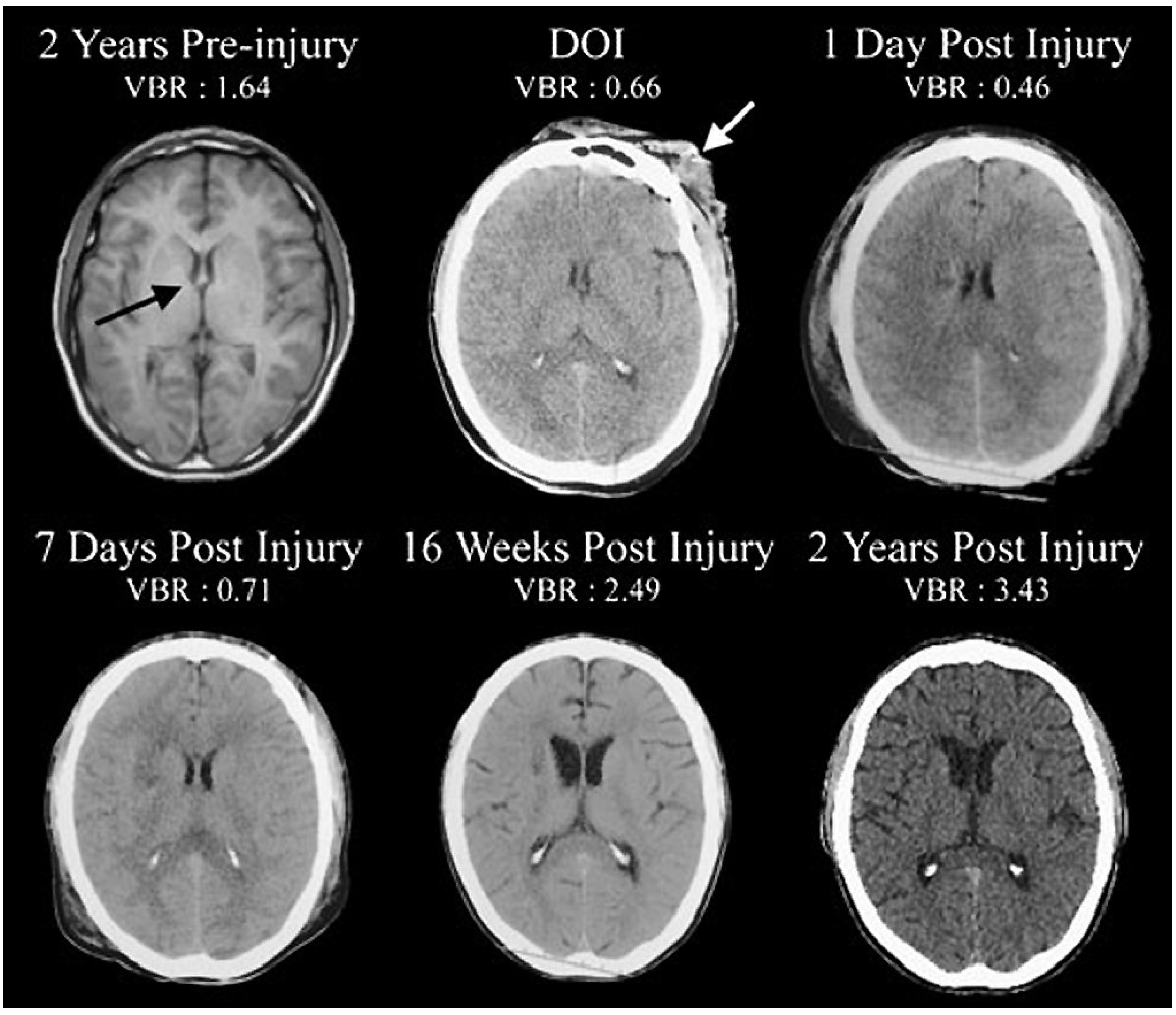 acute trauma