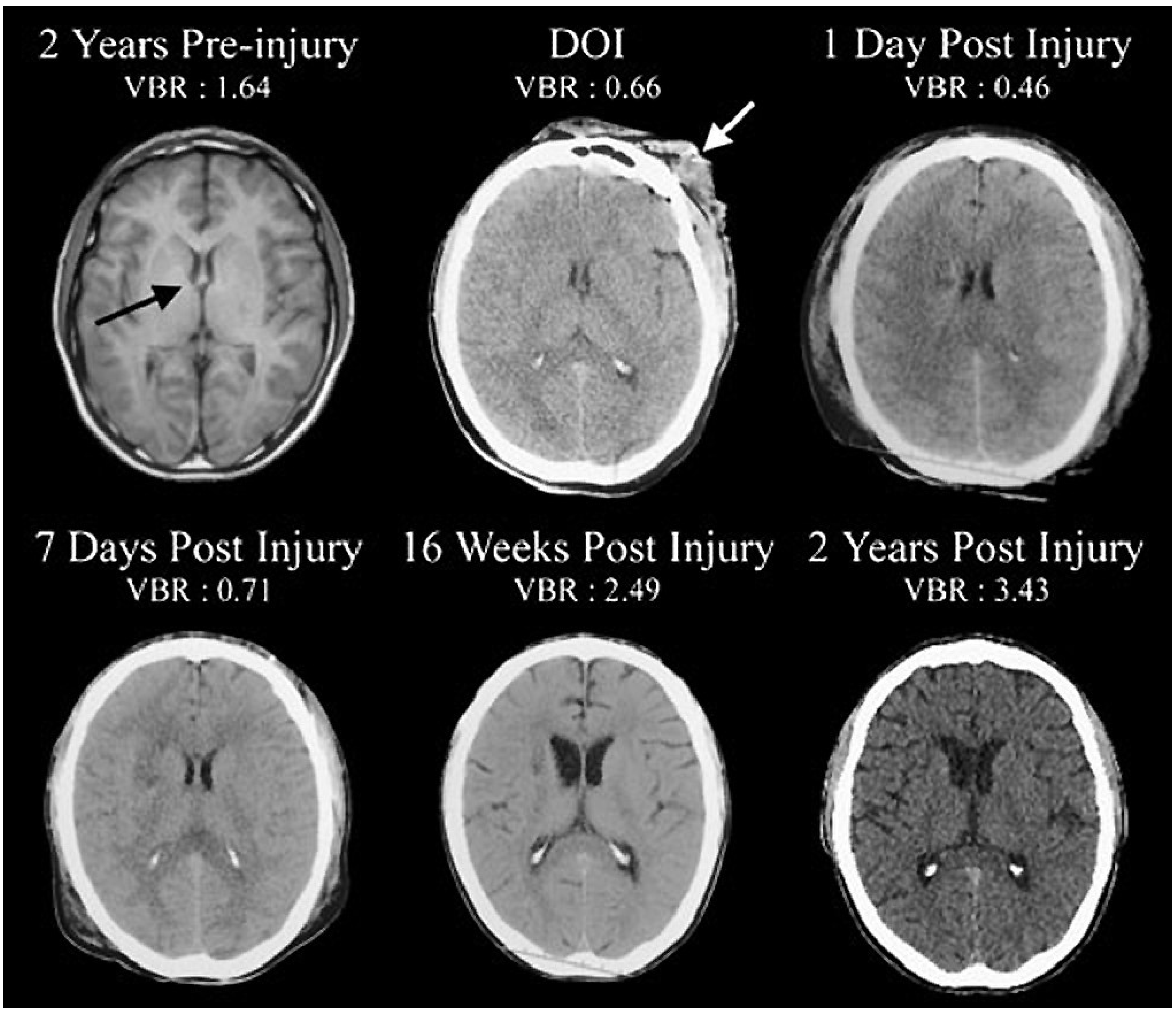 dissertations on brain injuries