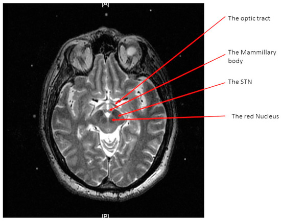 Brain Sciences | Free Full-Text | Using “Functional” Target Coordinates