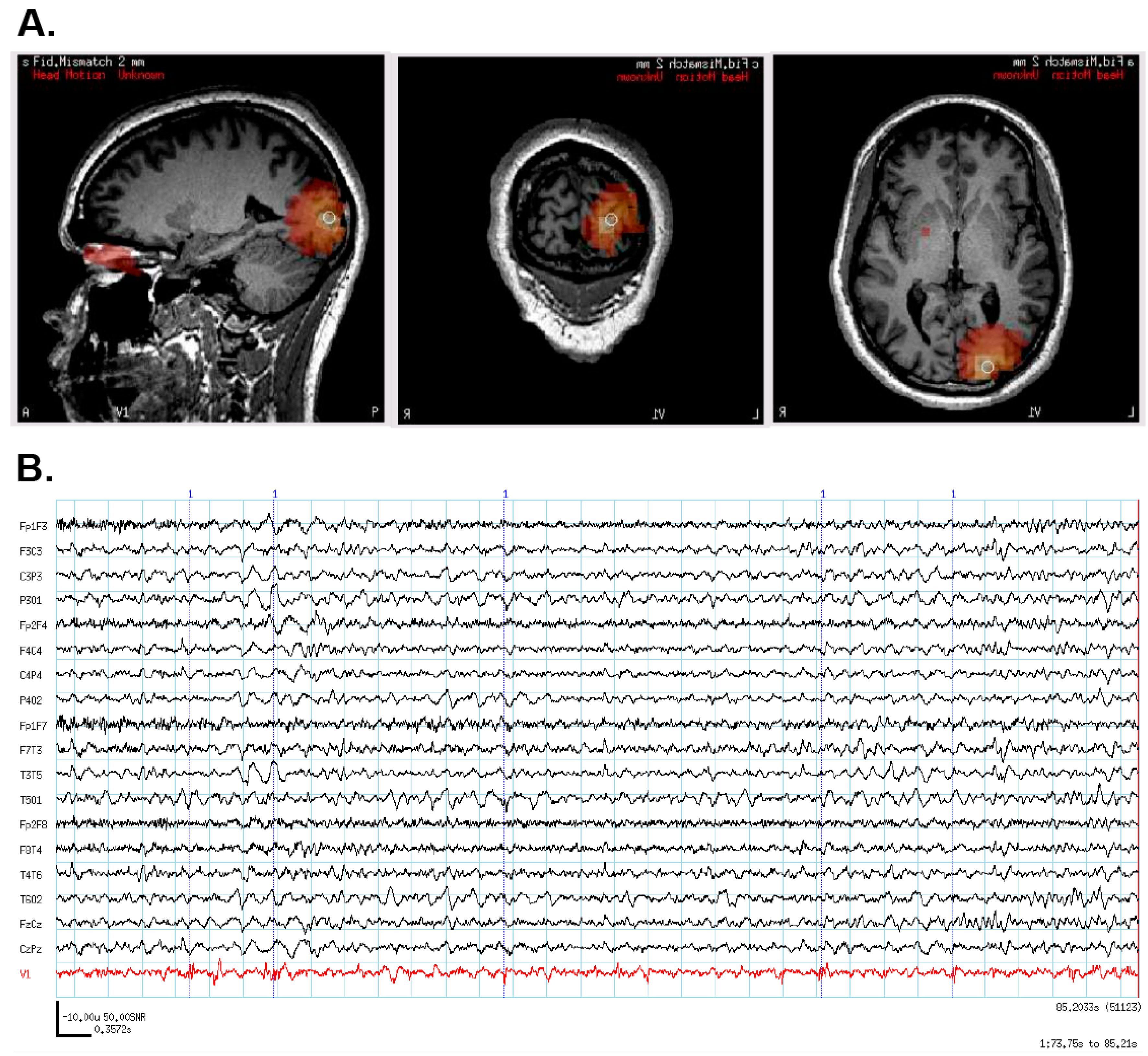brain injury endnote formate brain injury endnote formate
