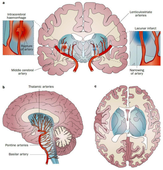 A human brain test bed for research in large vessel occlusion