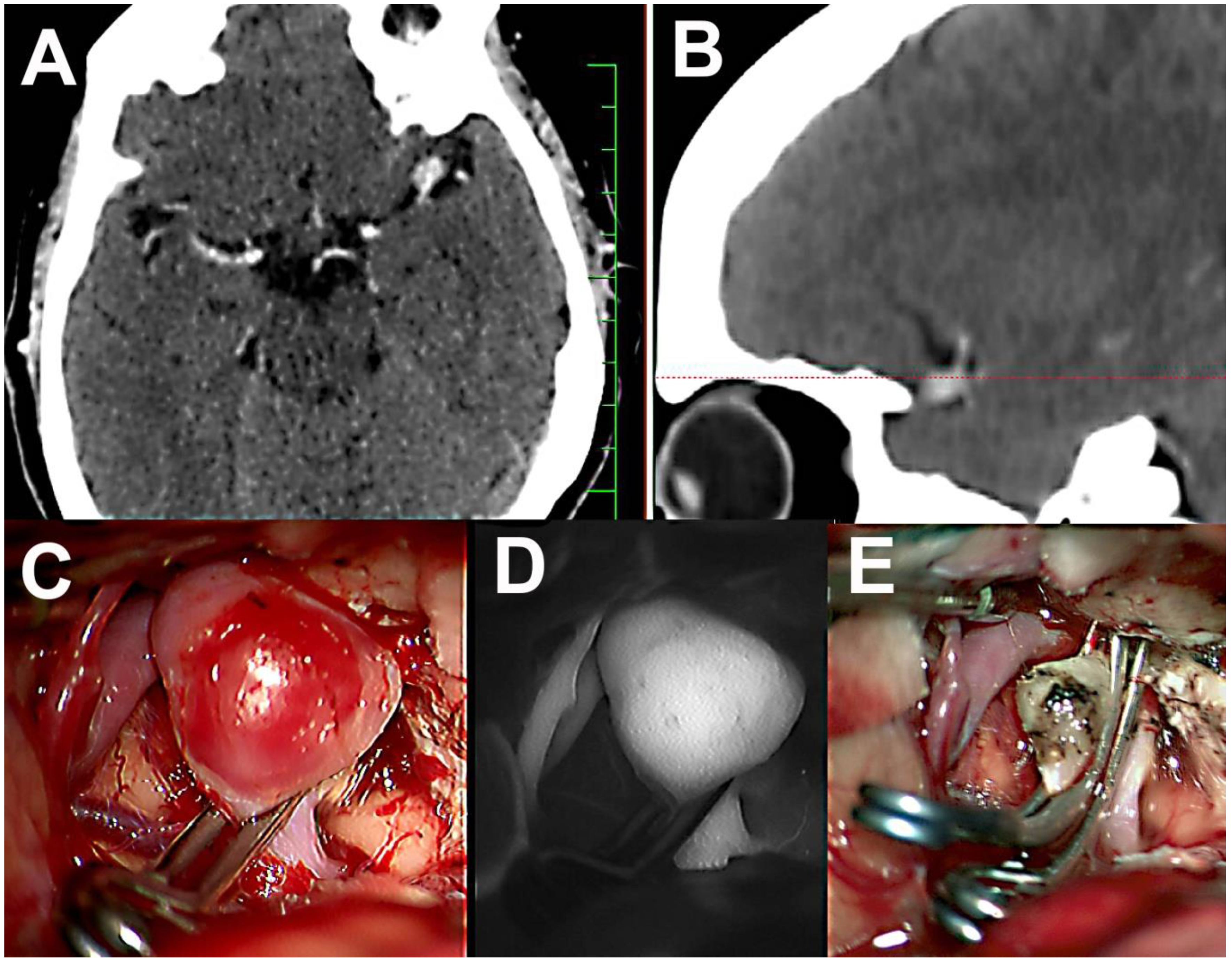 Spontaneous subarachnoid haemorrhage - The Lancet