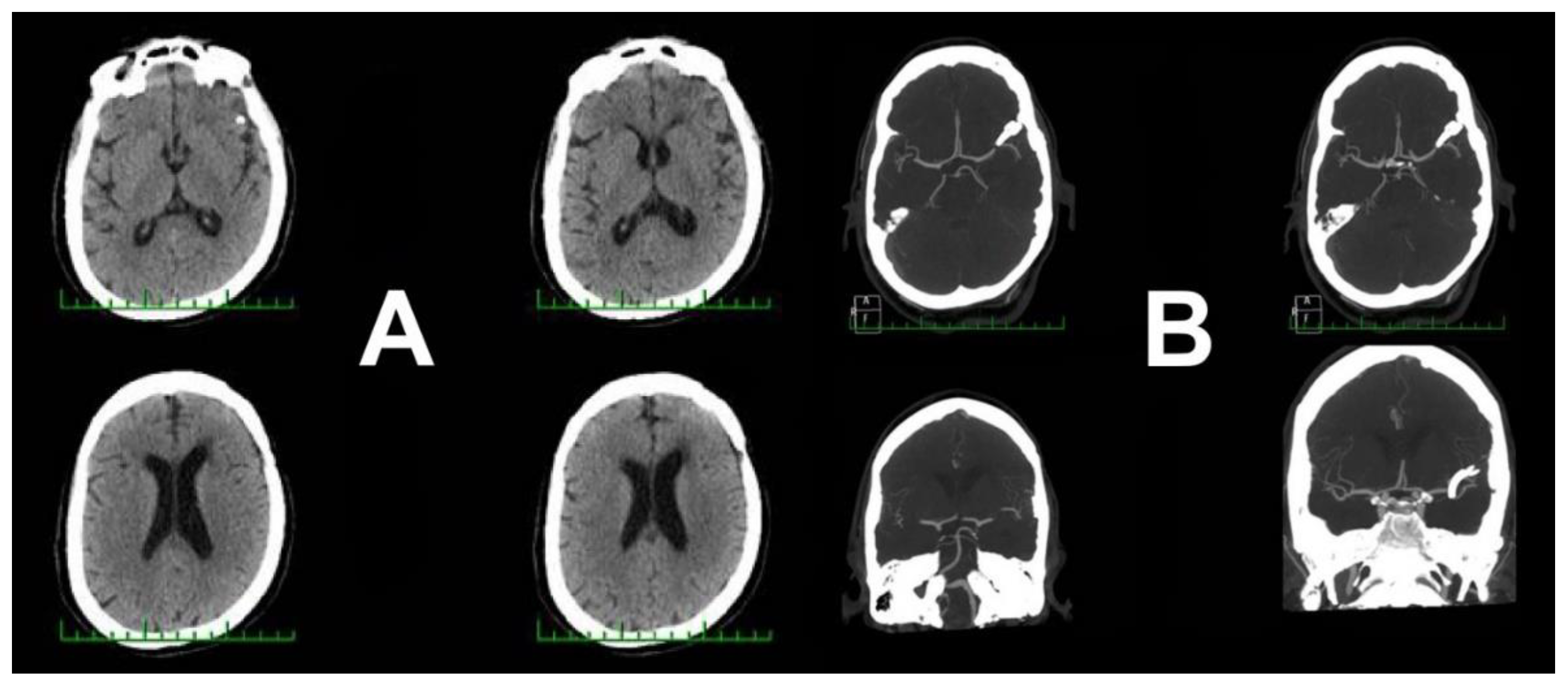 Delayed Ischemic Neurological Deficit after Uneventful