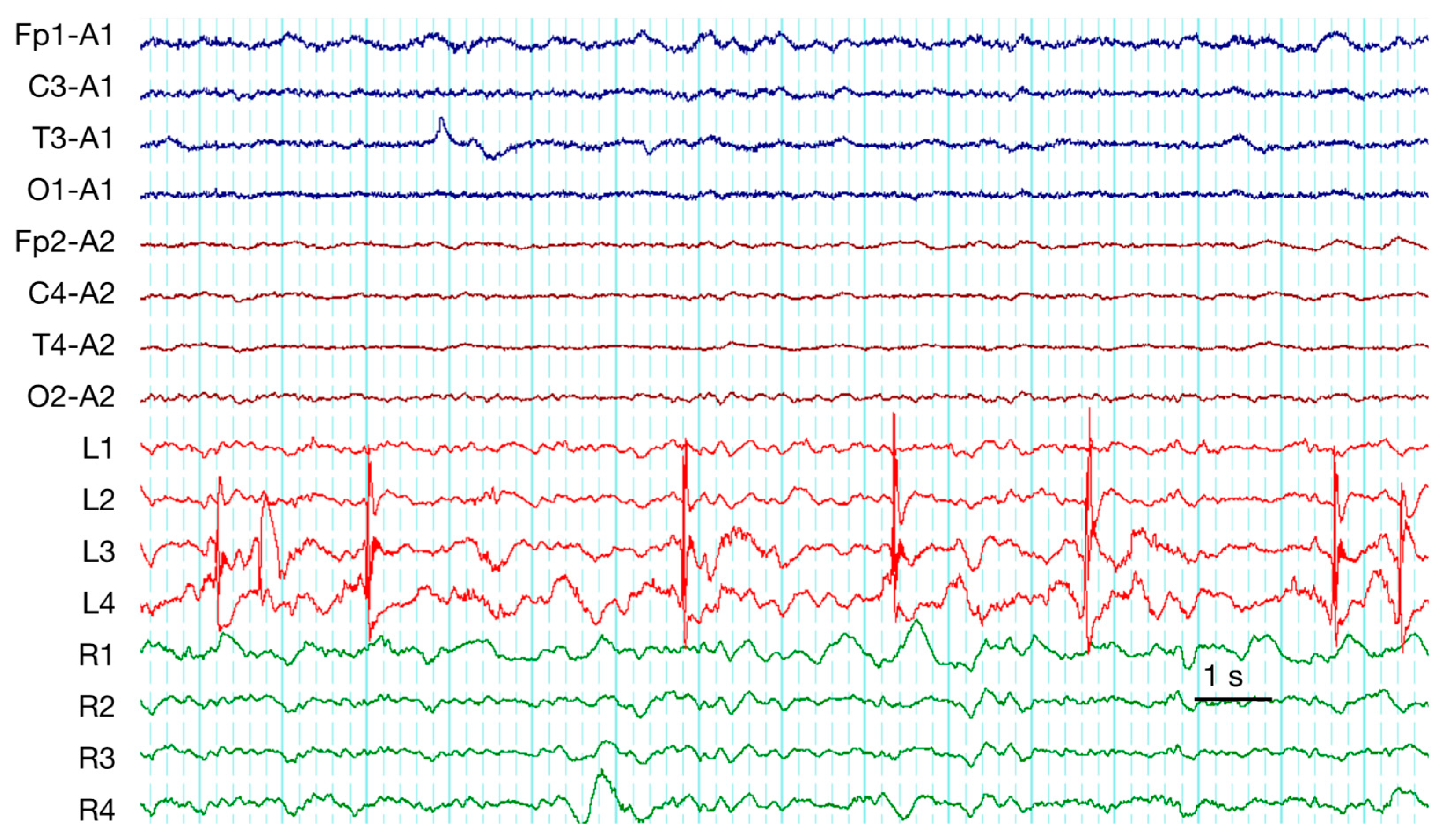 Brain Sciences Free Full Text A Translational Study On Acute Traumatic Brain Injury High Incidence Of Epileptiform Activity On Human And Rat Electrocorticograms And Histological Correlates In Rats Html Brain Sciences Free Full Text A Translational Study On Acute Traumatic Brain Injury High Incidence Of Epileptiform Activity On Human And Rat Electrocorticograms And Histological Correlates In Rats Html