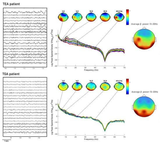 Channel spectra and map visualization of the beta band (13-30 Hz) of a
