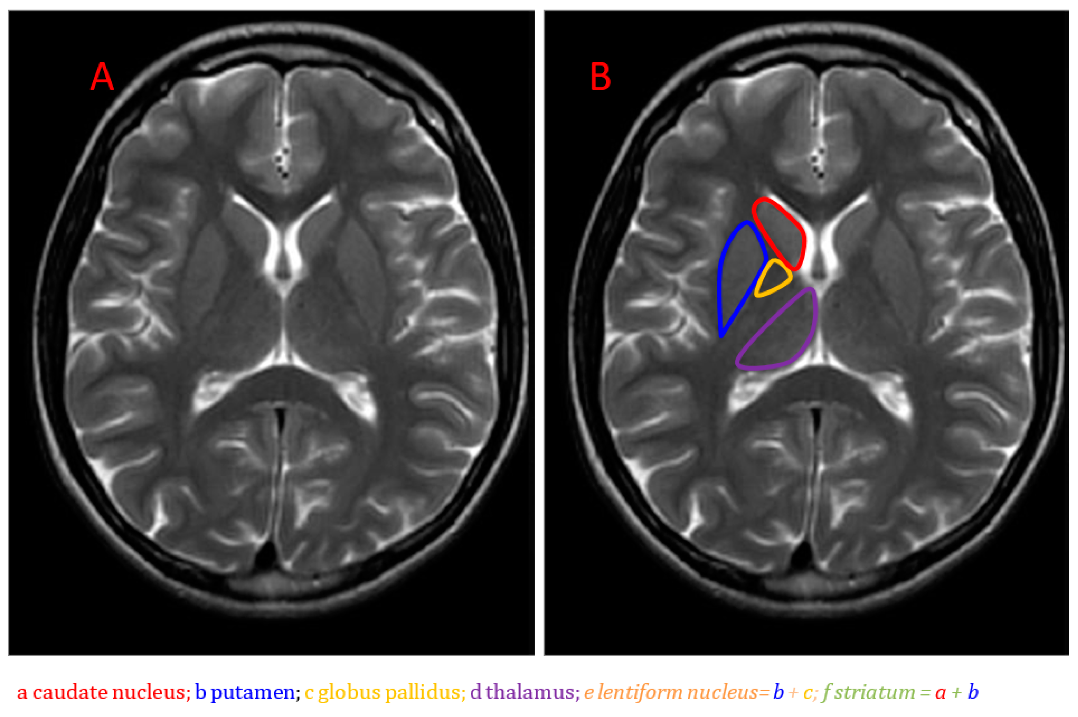 Basal Ganglia Lesions Basal Ganglia Mri Brain Brain Anatomy | Images ...