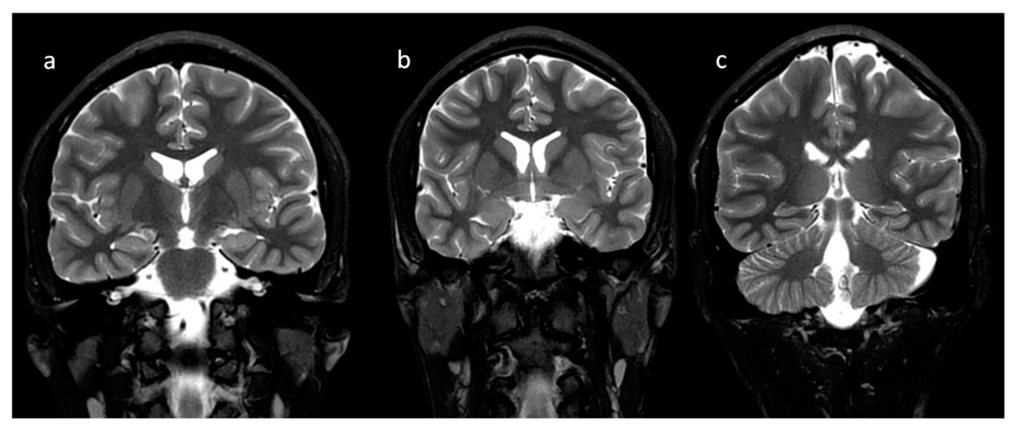 Brain Sciences Free Full Text Neuroimaging Of Basal Ganglia In Neurometabolic Diseases In Children Html Brain Sciences Free Full Text Neuroimaging Of Basal Ganglia In Neurometabolic Diseases In Children Html