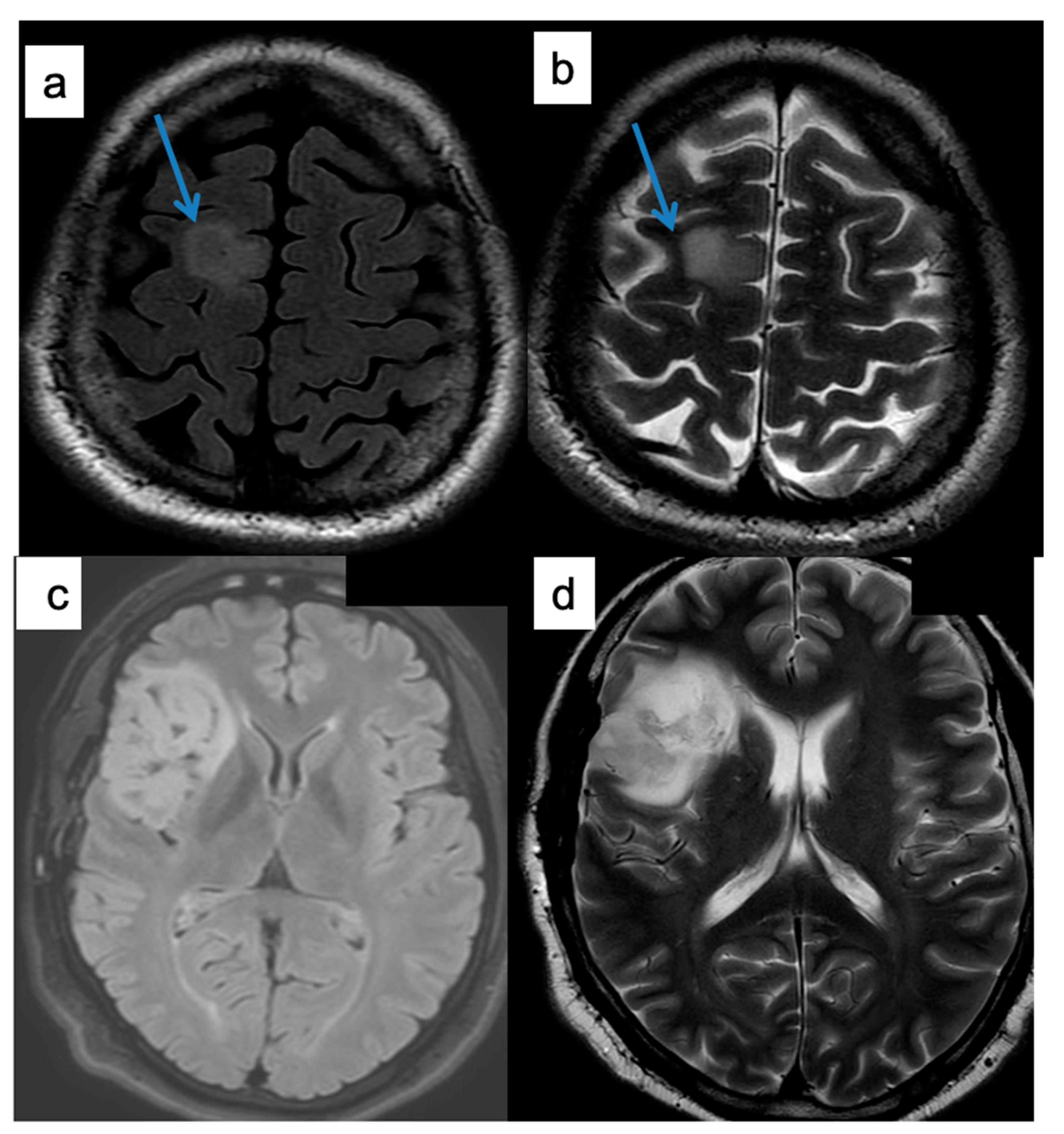Brain Sciences | Full-Text | The Role of the T2–FLAIR Mismatch Sign as Imaging Marker of IDH Status in a Mixed of Low- and High-Grade Gliomas