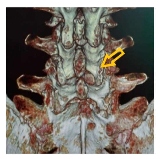 Brain Sciences Free FullText Clinical of Interlaminar