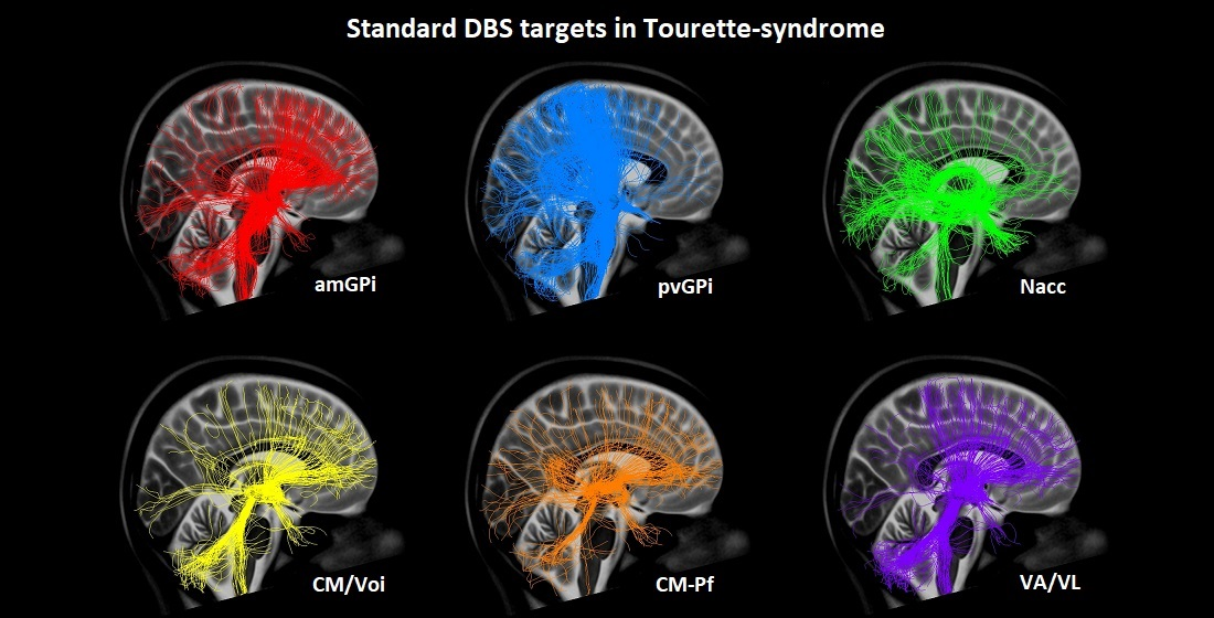 Brain Sciences | Free Full-Text | Connectivity Patterns of Deep Brain  Stimulation Targets in Patients with Gilles de la Tourette Syndrome