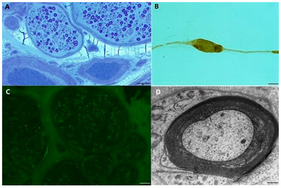 Mechanisms of Nerve Damage in Neuropathies Associated with