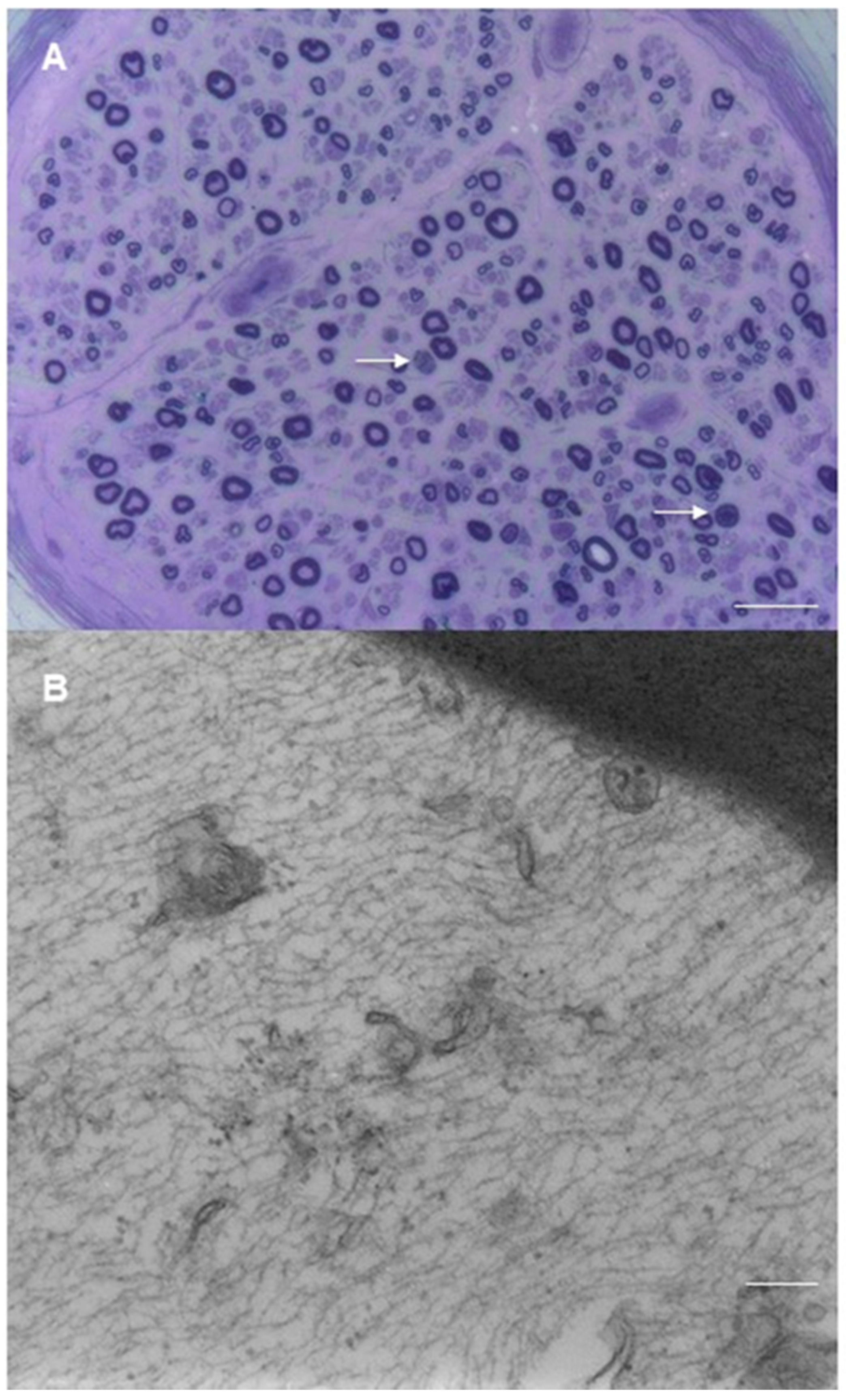 Mechanisms of Nerve Damage in Neuropathies Associated with