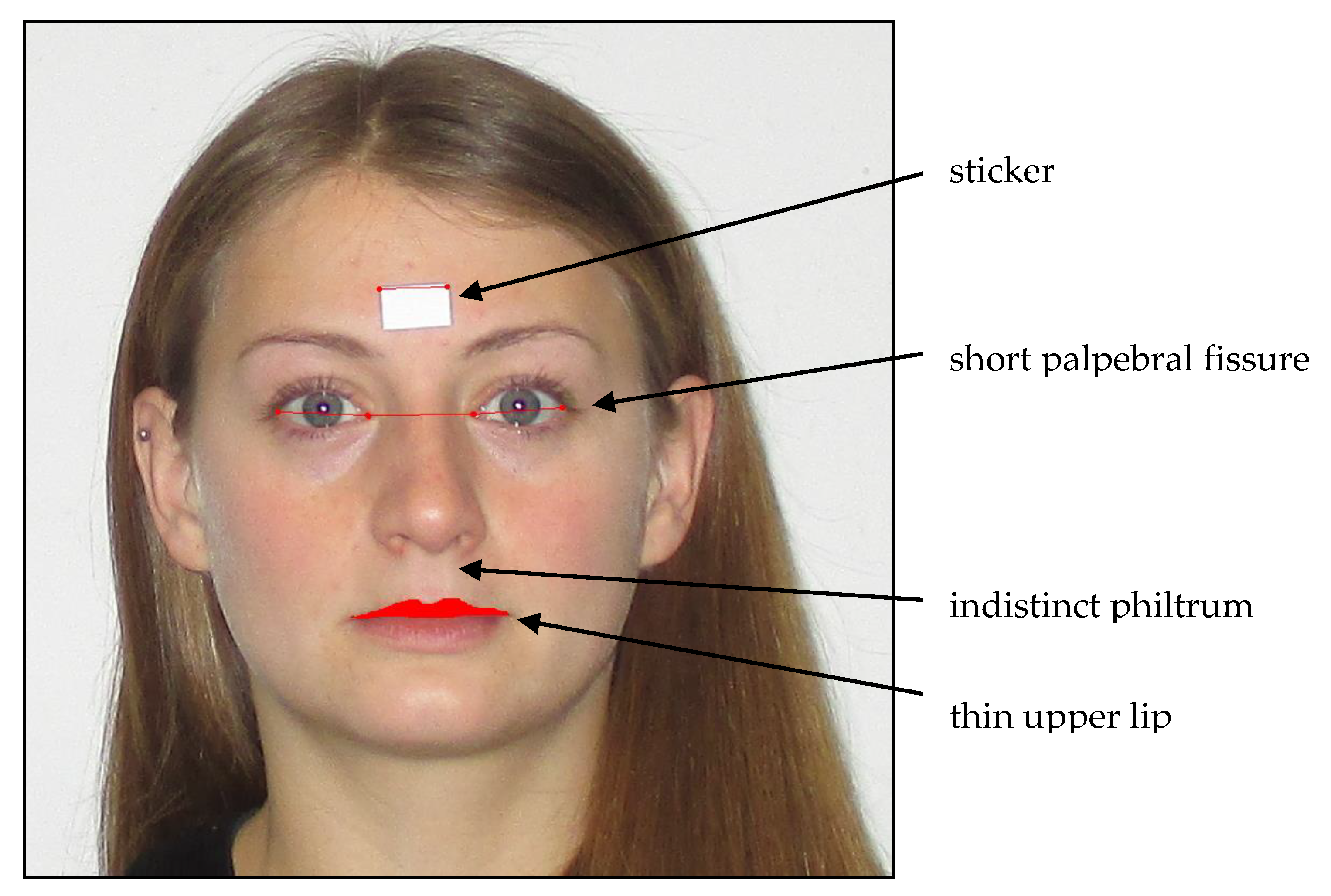 Fetal alcohol syndrome images adults