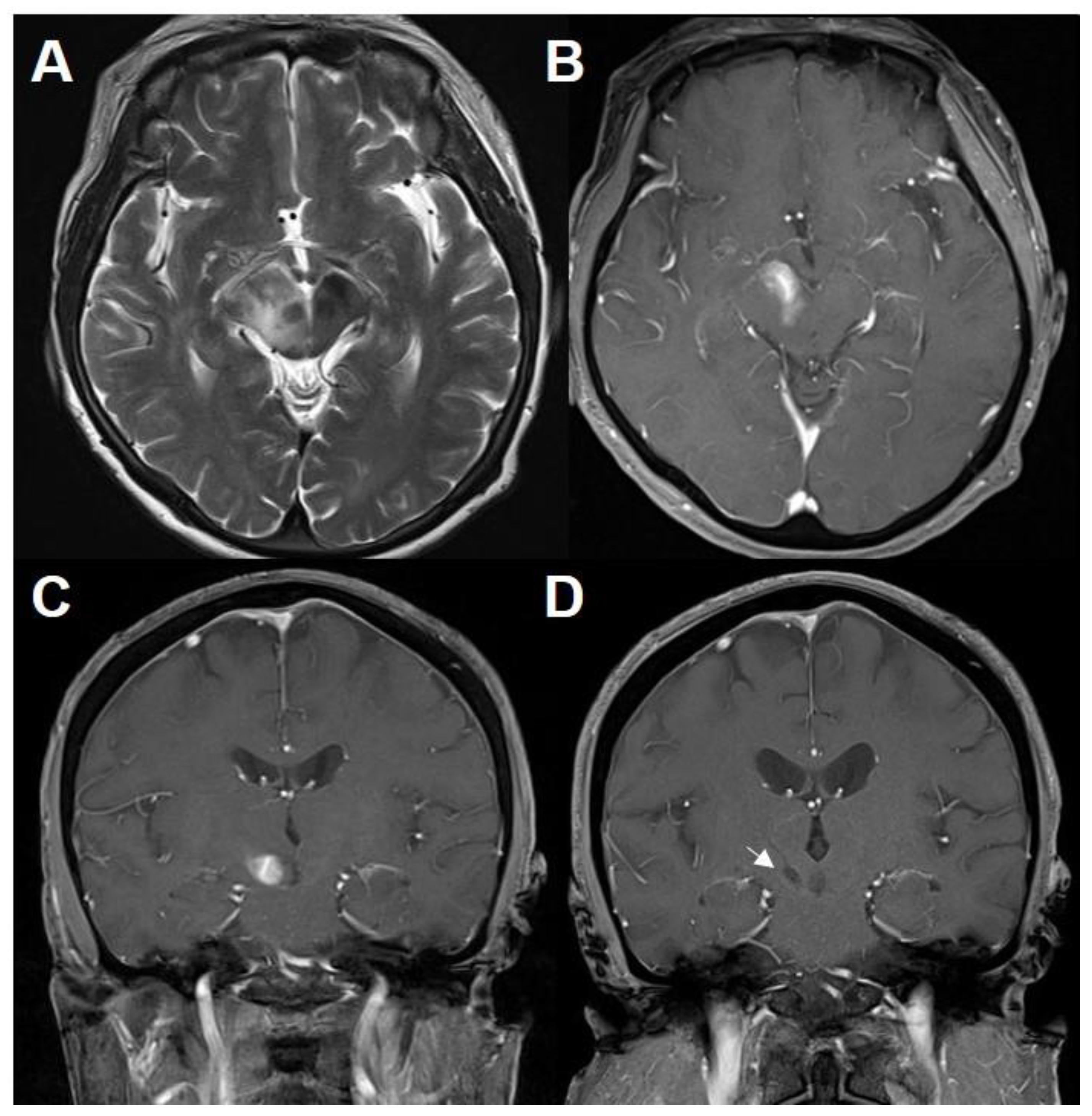 J. Imaging | Free Full-Text | Brain and Spinal Cord MRI Findings in Thai  Multiple Sclerosis Patients