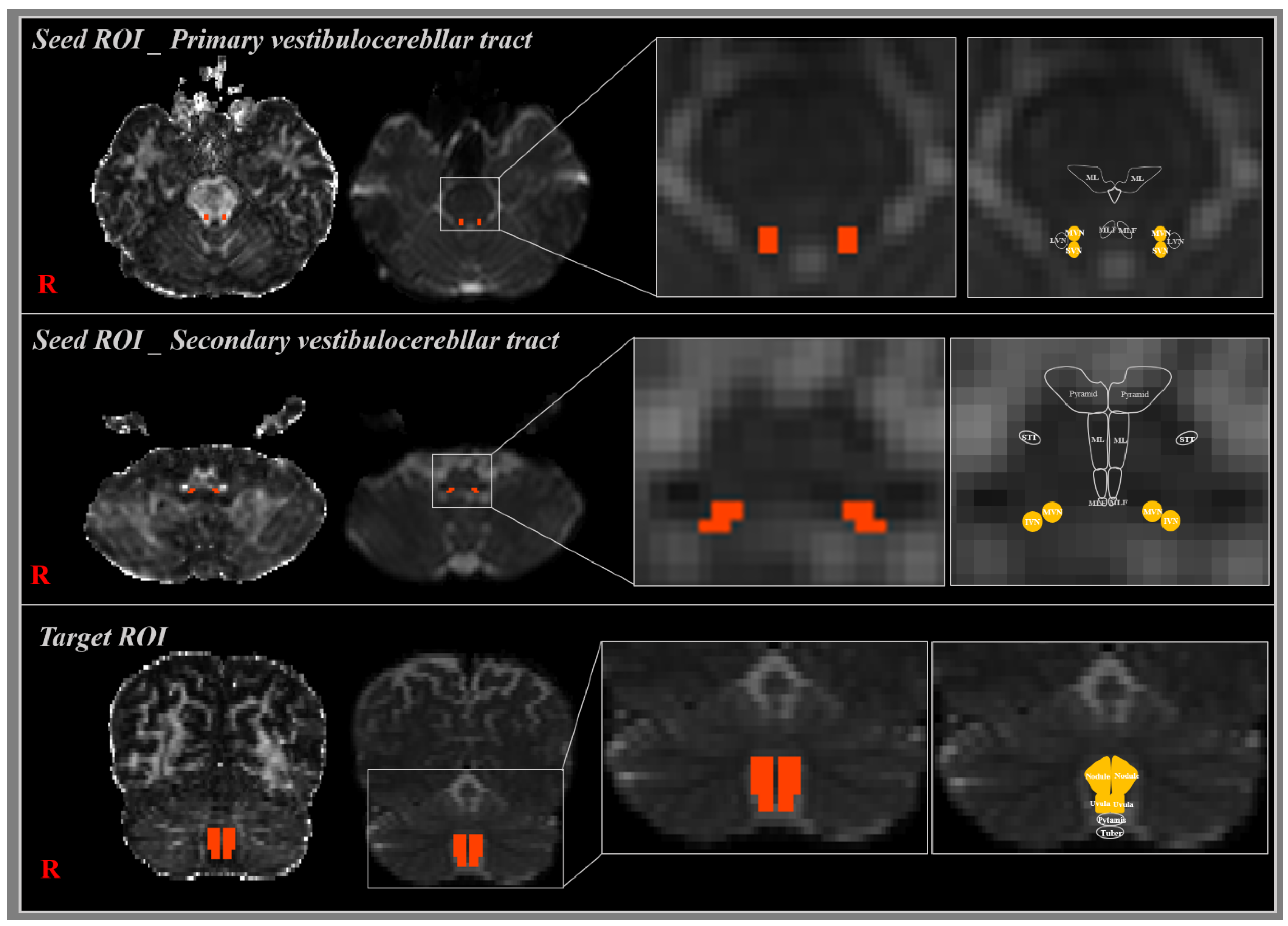 Brain Sciences Free Full Text Anatomical Location Of The Vestibulocerebellar Tract In The Healthy Human Brain A Diffusion Tensor Imaging Study Brain Sciences Free Full Text Anatomical Location Of The Vestibulocerebellar Tract In The Healthy Human Brain A Diffusion Tensor Imaging Study