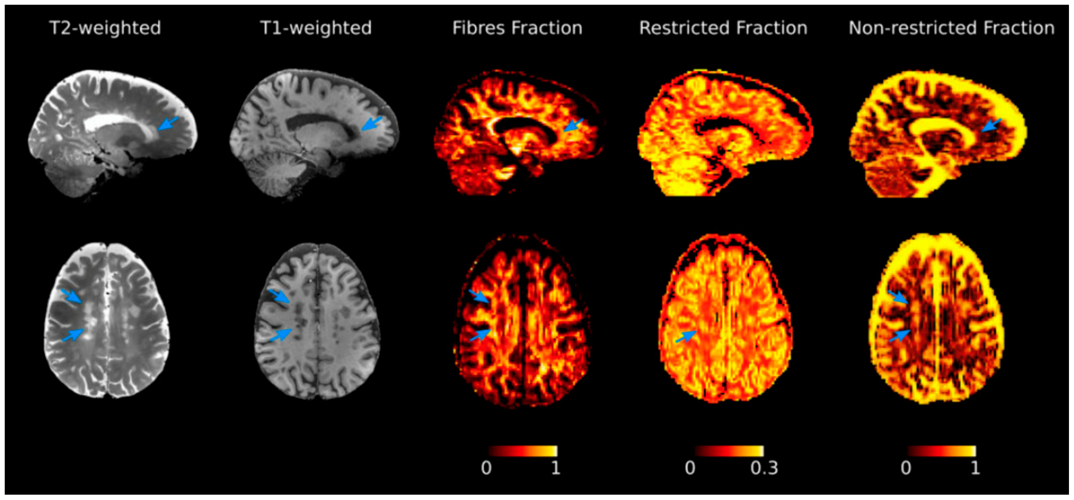 Brain Sciences Free Full Text Neuroimaging Correlates Of Cognitive Dysfunction In Adults With Multiple Sclerosis Html Brain Sciences Free Full Text Neuroimaging Correlates Of Cognitive Dysfunction In Adults With Multiple Sclerosis Html