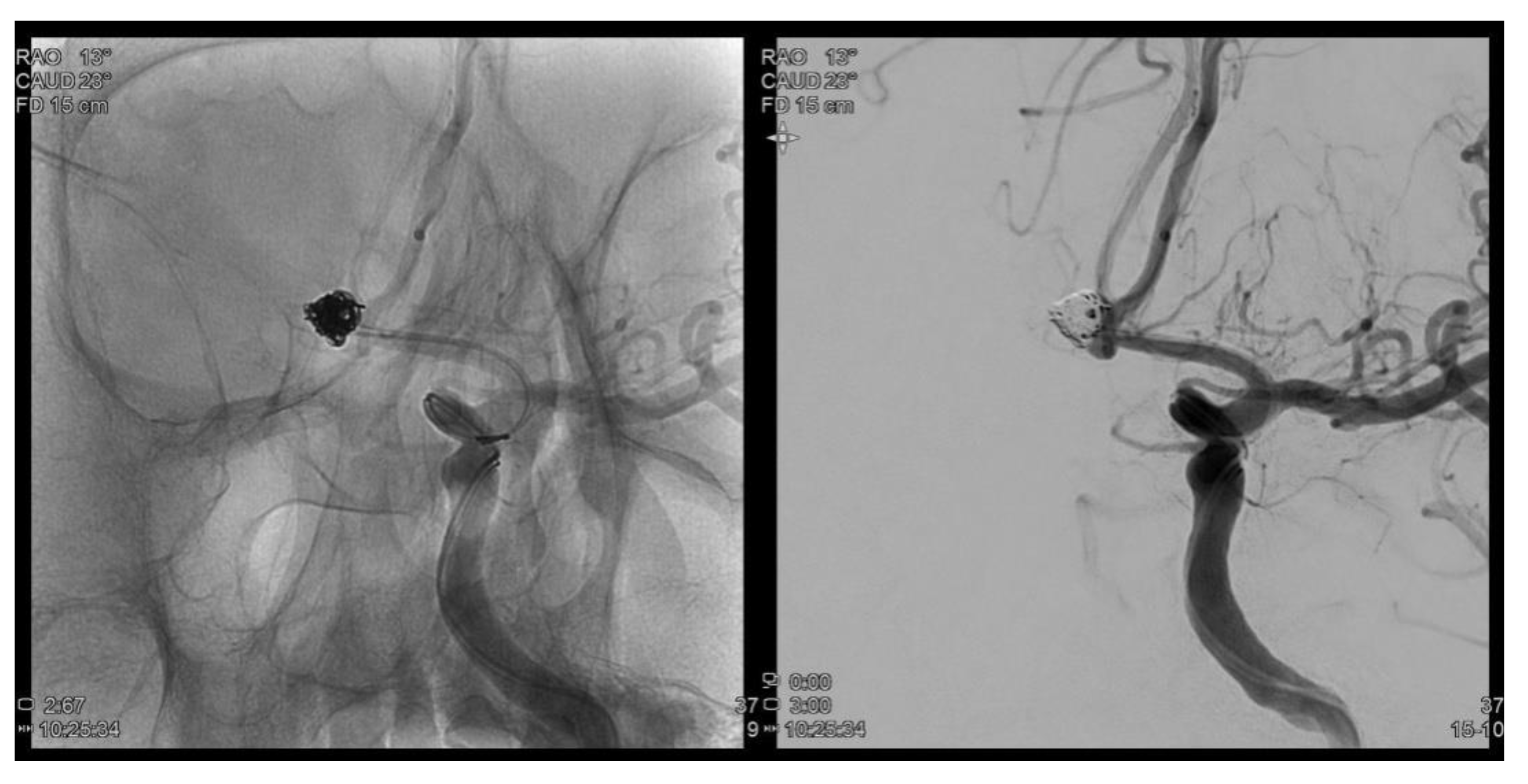 life expectancy after unruptured aneurysm coiling